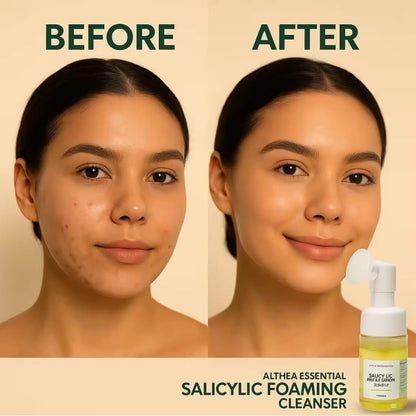 Kojie San Salicylic Acid Facial Foam 100ml | Nettoyant Visage Purifiant Anti-Imperfections