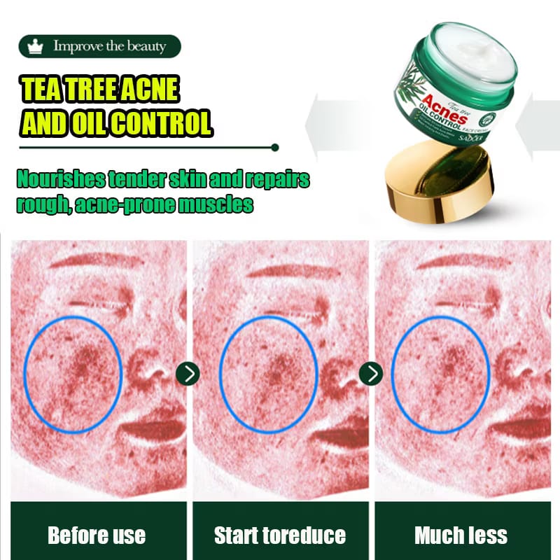 Acnè Oil Control Tea Tree Cream 50 g – Soin Visage Purifiant & Contrôle du Sébum