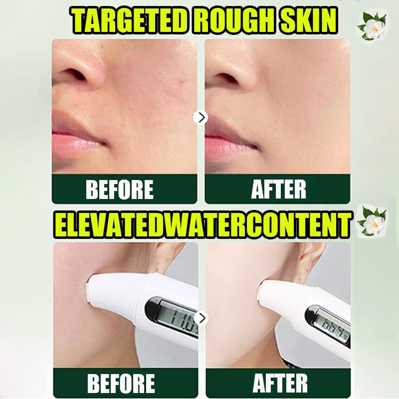 Acnè Oil Control Tea Tree Cream 50 g – Soin Visage Purifiant & Contrôle du Sébum
